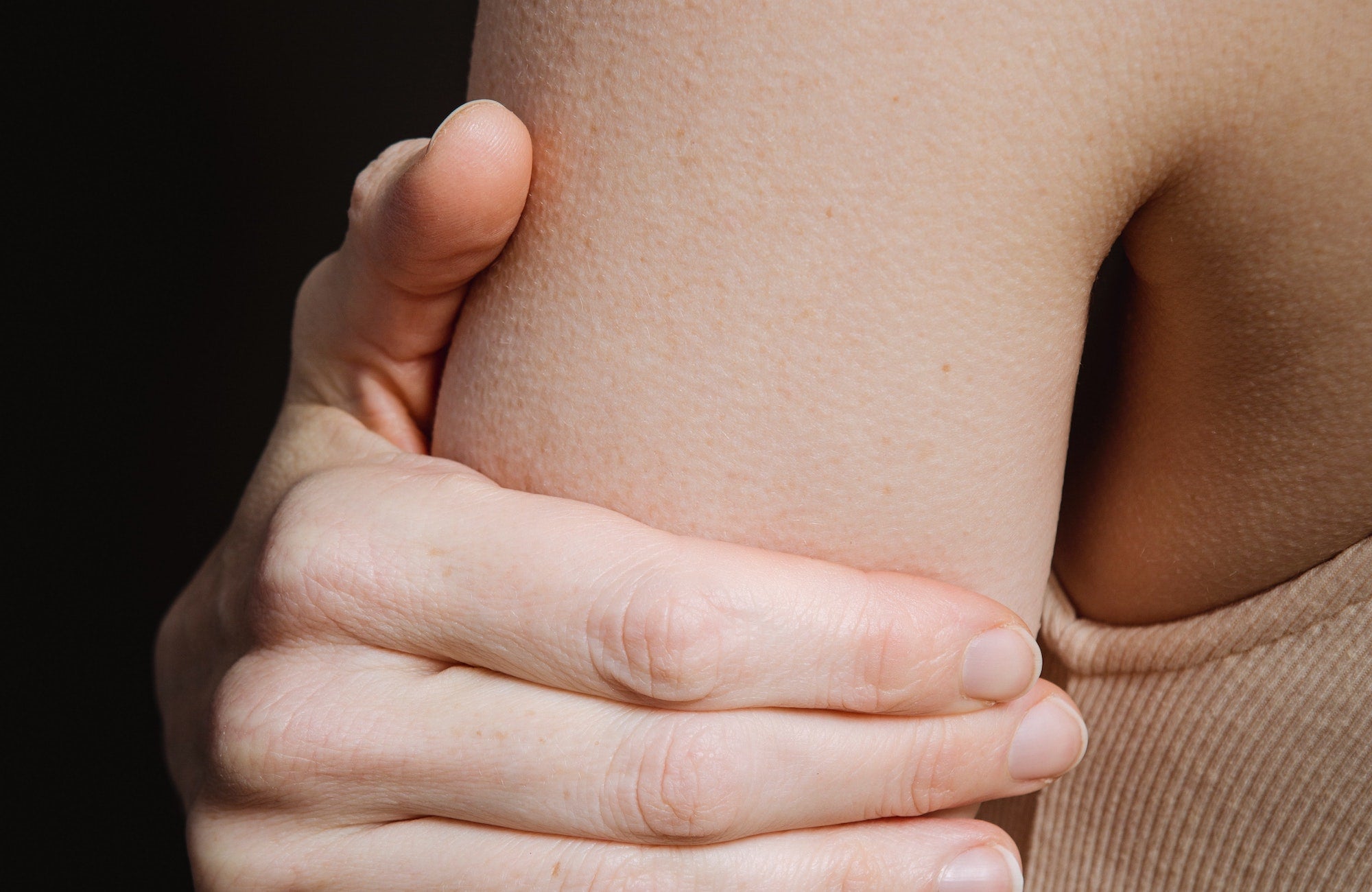 The Best Keratosis Pilaris Treatment to Improve Your Bumpy Skin!